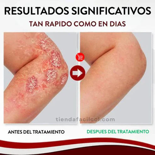 KOLMAX – Cuidado dermatológico con eliminación total.