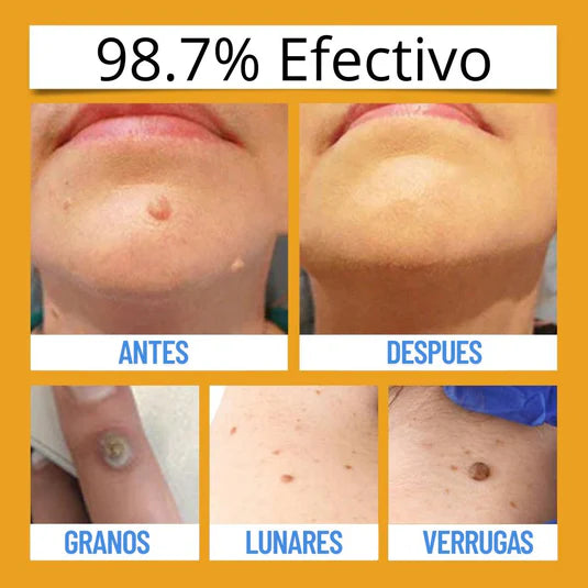🐝 TAG RECEDE – ¡Dile Adiós a Verrugas, Lunares y Manchas en Pocos Días!