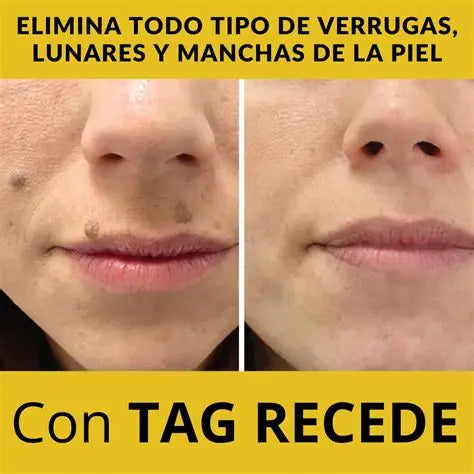 🐝 TAG RECEDE – ¡Dile Adiós a Verrugas, Lunares y Manchas en Pocos Días!